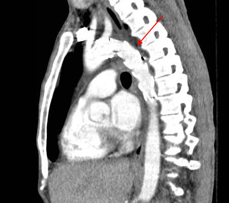 Traumatic Aortic Injury. Sag CT 2 Annotated. JETem 2016