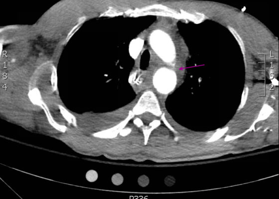 Traumatic Aortic Injury. Trans CT 1, Annotated. JETem 2016