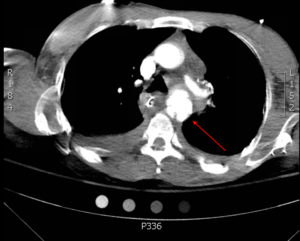 Traumatic Aortic Injury. Trans CT 2, Annotated. JETem 2016