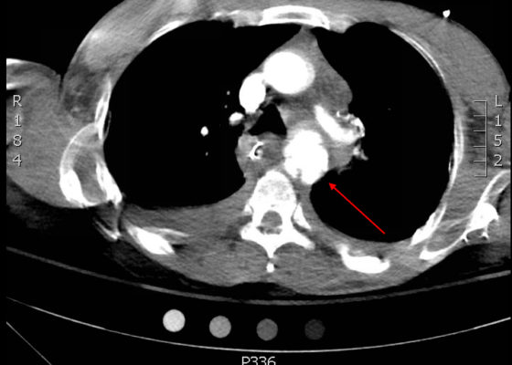 Traumatic Aortic Injury. Trans CT 2, Annotated. JETem 2016