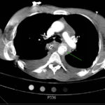 Traumatic Aortic Injury. Trans CT 3, Annotated. JETem 2016
