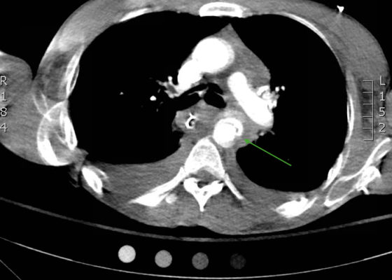 Traumatic Aortic Injury. Trans CT 3, Annotated. JETem 2016