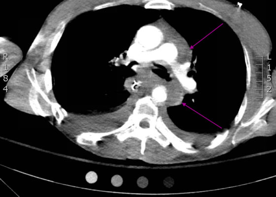 Traumatic Aortic Injury. Trans CT 4, Annotated. JETem 2016