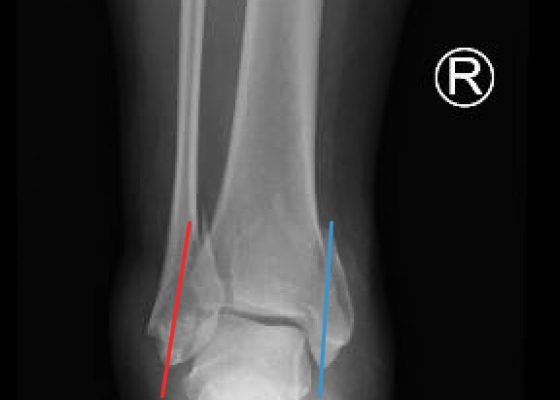 Trimalleolar Fracture, AP XRay, Annotated. JETem 2016