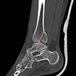 Trimalleolar Fracture, Lateral CT, Annotated. JETem 2016