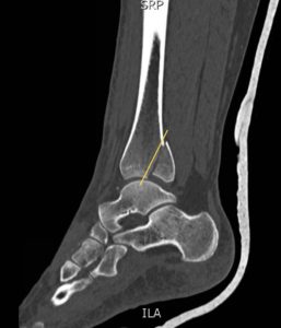 Trimalleolar Fracture, Lateral CT, Annotated. JETem 2016