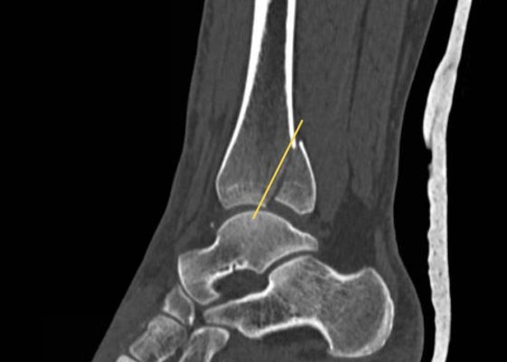 Trimalleolar Fracture, Lateral CT, Annotated. JETem 2016