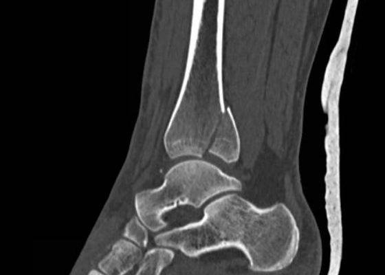 Trimalleolar Fracture, Lateral CT. JETem 2016