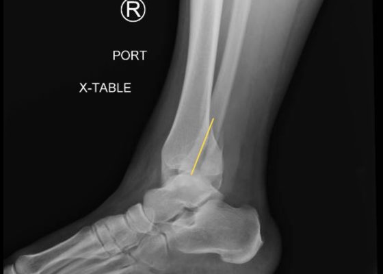 Trimalleolar Fracture, Lateral XRay, Annotated. JETem 2016