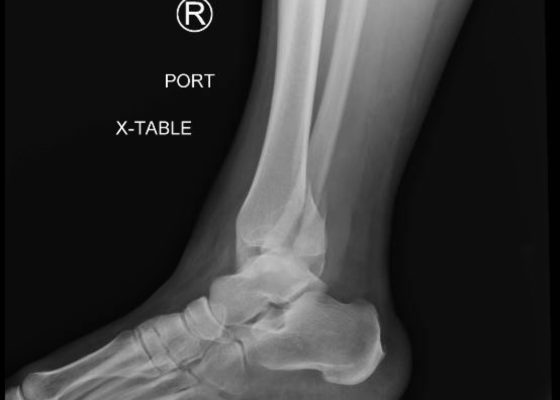 Trimalleolar Fracture, Lateral XRay. JETem 2016