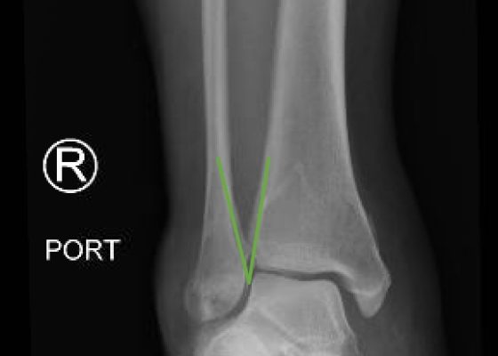 Trimalleolar Fracture, Oblique XRay, Annotated. JETem 2016