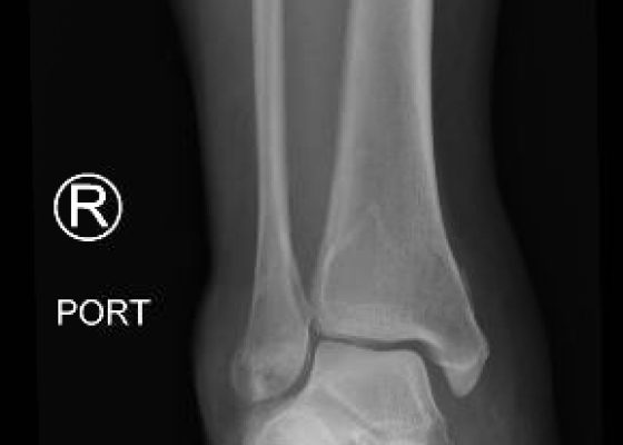 Trimalleolar Fracture, Oblique XRay. JETem 2016