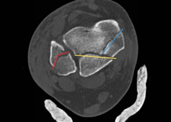 Trimalleolar Frcture, Transverse CT, Annotated. JETem 2016