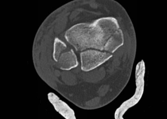 Trimalleolar Frcture, Transverse CT. JETem 2016