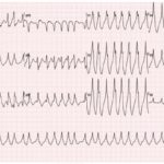 WPW EKG 1, initial EKG. JETem 2016