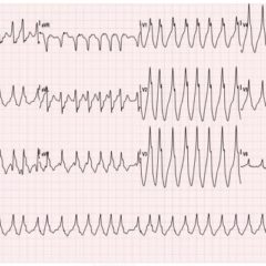 WPW EKG 1, initial EKG. JETem 2016
