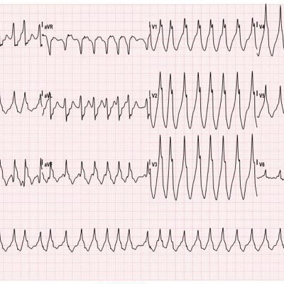 Wolff-Parkinson-White Syndrome: Electrocardiogram - JETem