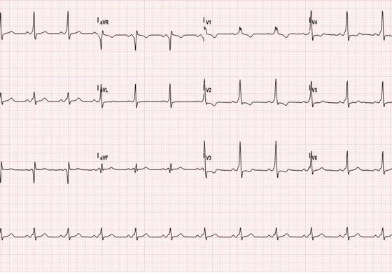 WPW EKG 3, after procainamide infusion. JETem 2016