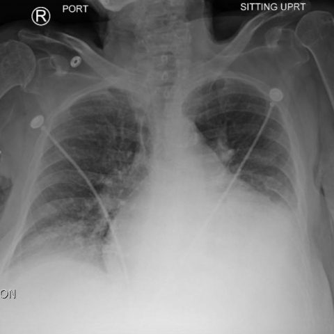 Congestive Heart Failure X-Ray - JETem