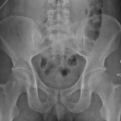 Hip Dislocation Pre and Post Reduction XR - JETem