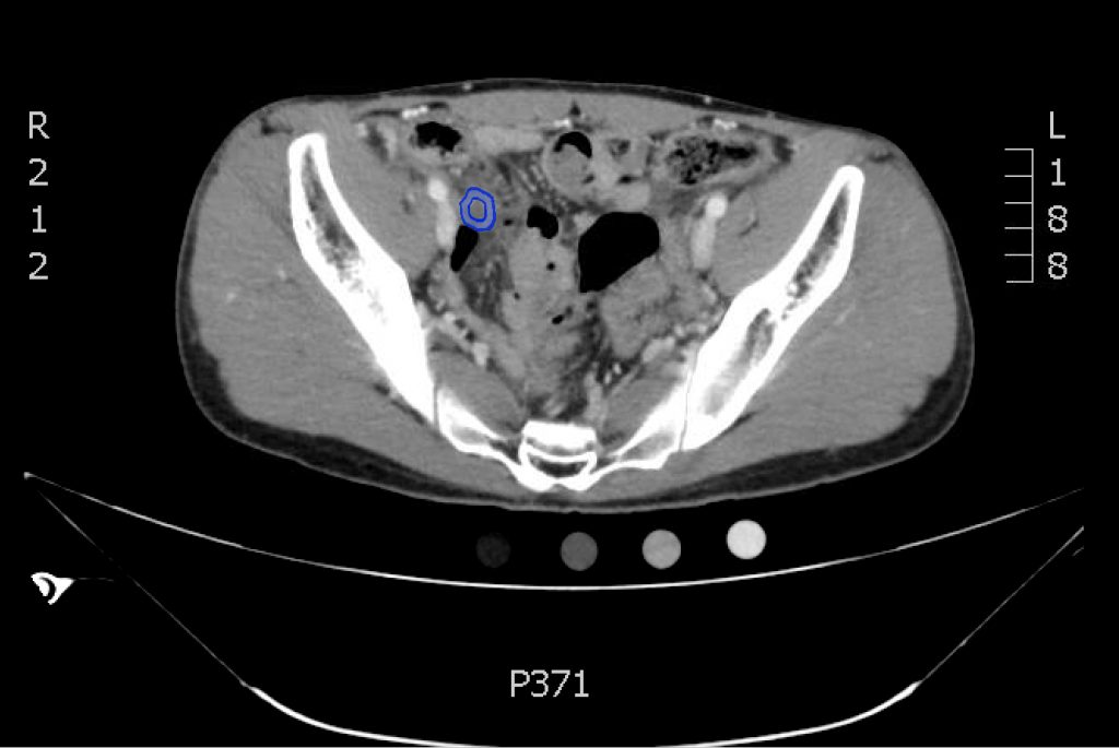 Appendicitis, CT Axial, Hyperenhancing Annotated. JETem 2017 - JETem