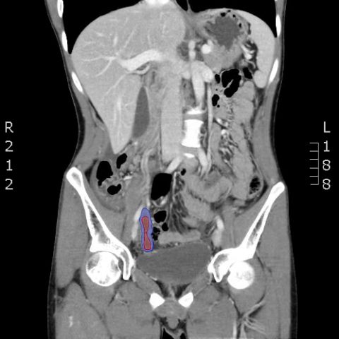 Computed Tomography Diagnosis of Appendicitis - JETem