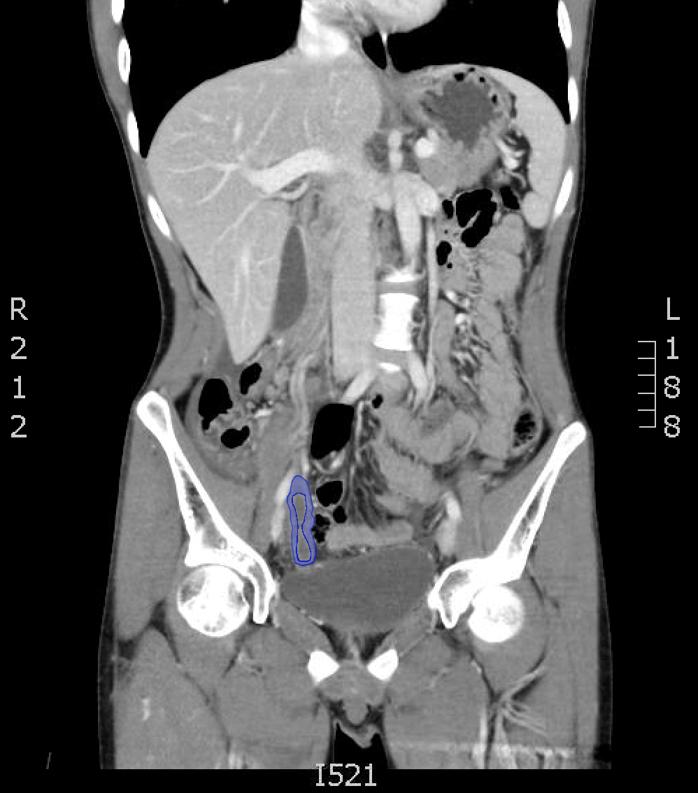 Ruptured Appendix X Ray
