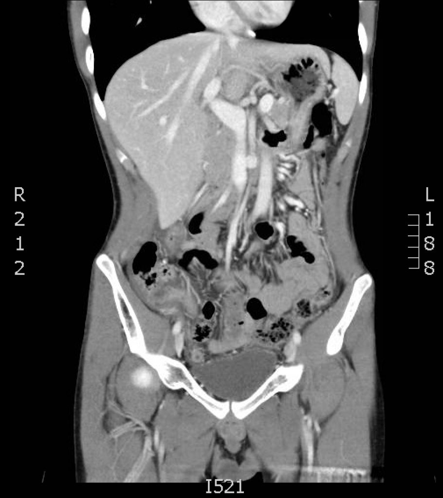 Appendicitis, CT Coronal Slice 1. JETem 2017 - JETem