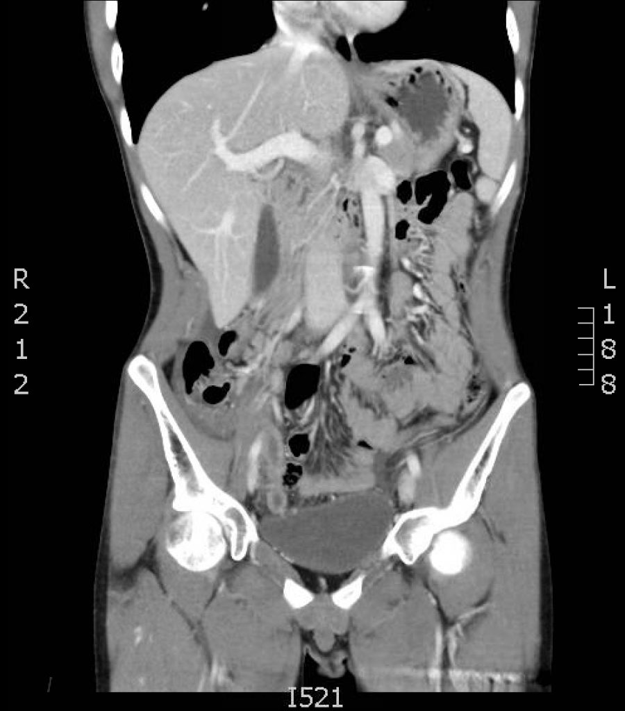 Appendicitis, CT Coronal Slice 2. JETem 2017 - JETem