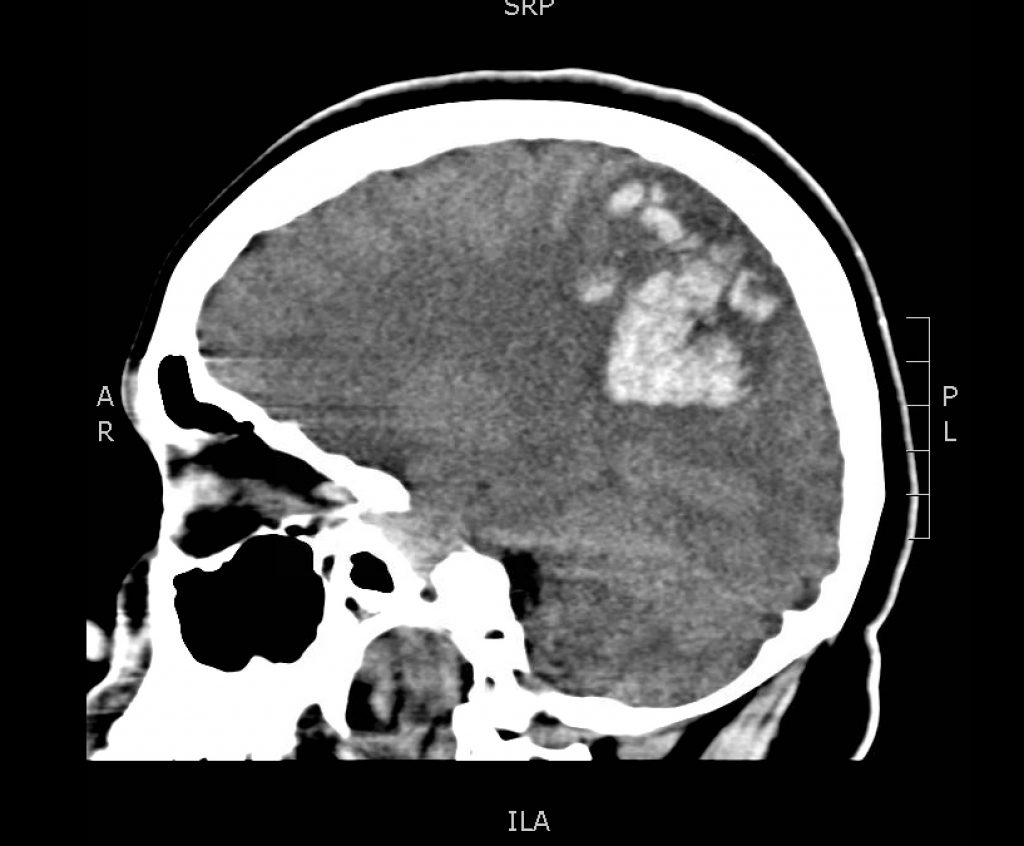 brain-bleed-ct-sagital-jetem-2017-jetem