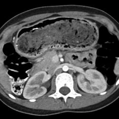 Gastric Bezoar - JETem