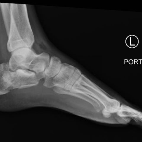 Calcaneal Fractures and Böhler’s Angle - JETem