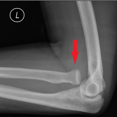 Monteggia Fracture In An Assault Patient - Jetem