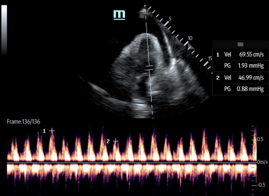 Bedside Echocardiography For Rapid Diagnosis Of Malignant Cardiac