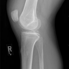 Pseudogout and Calcium Pyrophosphate Disease - JETem