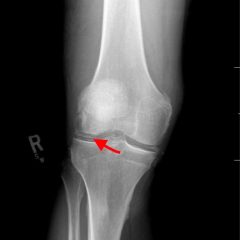 Pseudogout and Calcium Pyrophosphate Disease - JETem