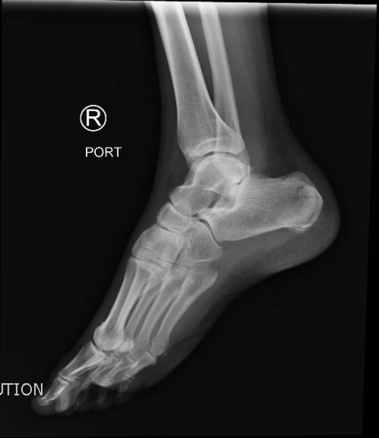 icd 10 r calcaneal fracture