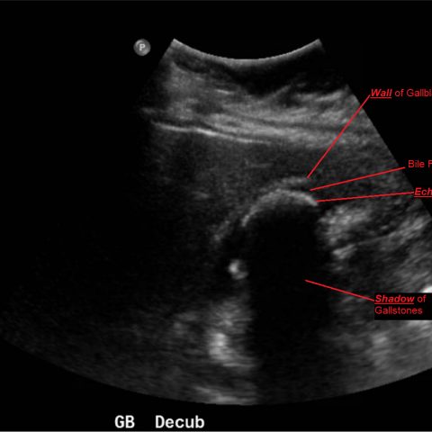 Cholelithiasis: WES Sign - JETem