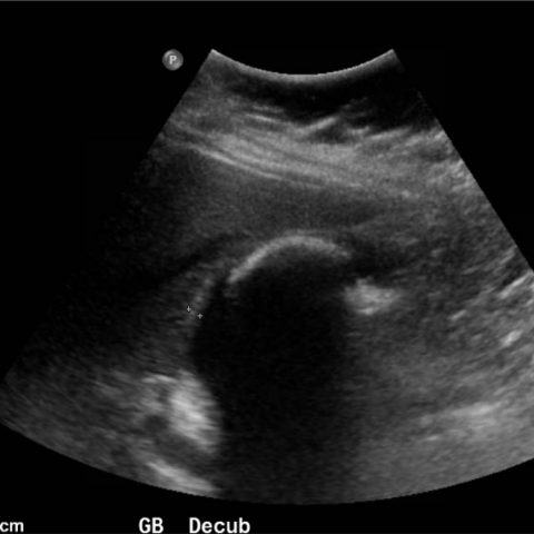 Cholelithiasis: WES Sign - JETem