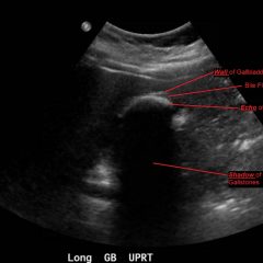 Cholelithiasis: WES Sign - JETem