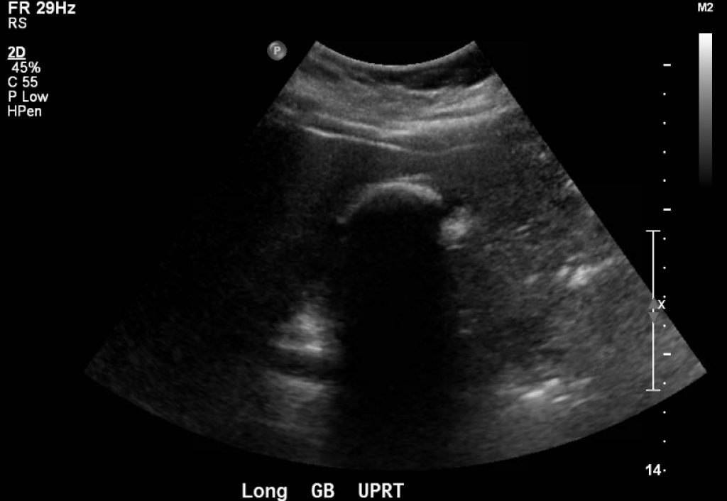 WES Ultrasound Upright. JETem 2017 - JETem