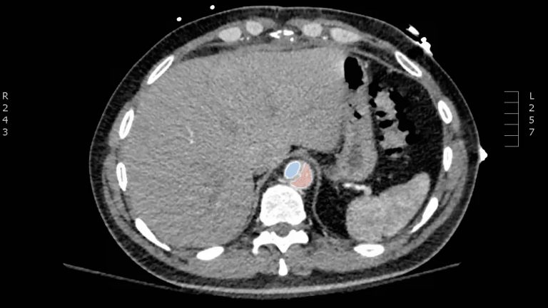 Acute Aortic Dissection Presenting Exclusively as Lower Extremity ...