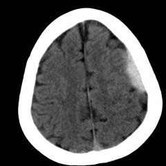 Acute Subdural Hematoma - Jetem