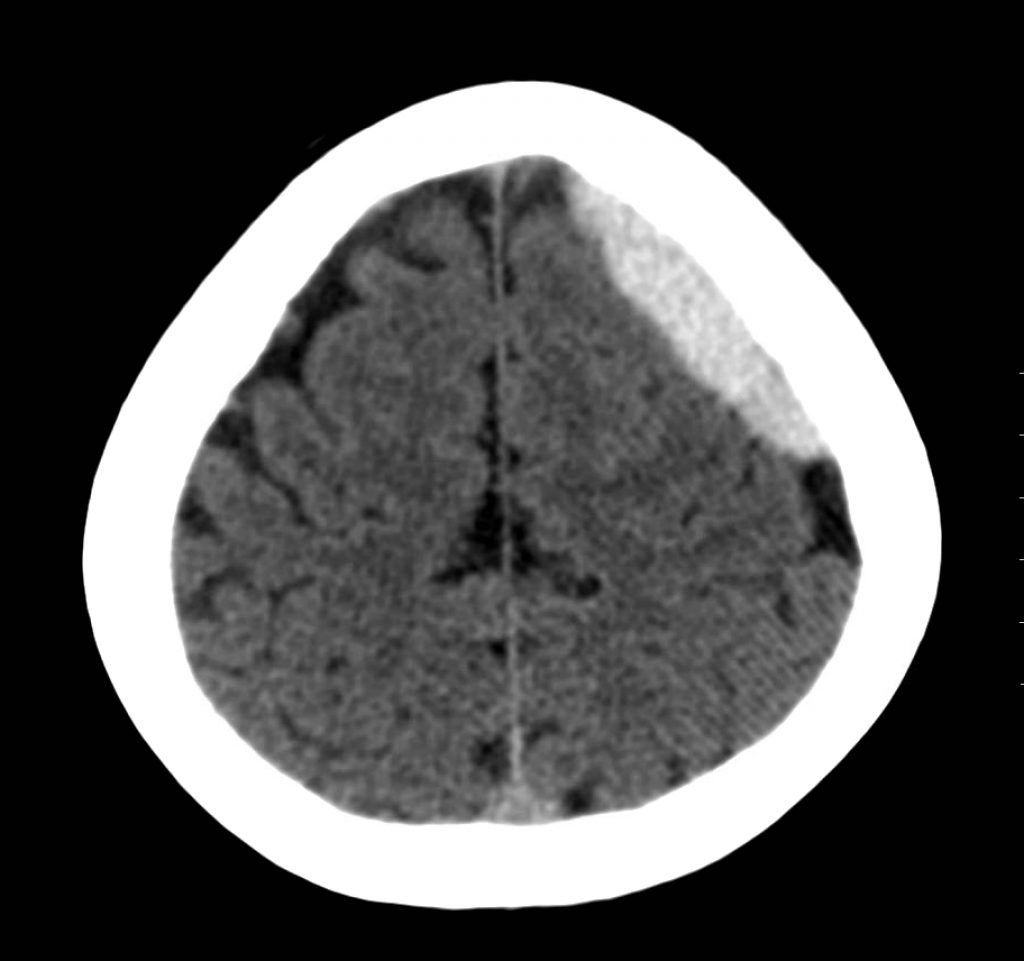 Acute Subdural Hematoma Ct Axial 2 Jetem 2017 Jetem