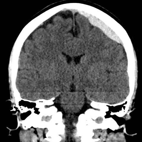 Acute Subdural Hematoma - JETem