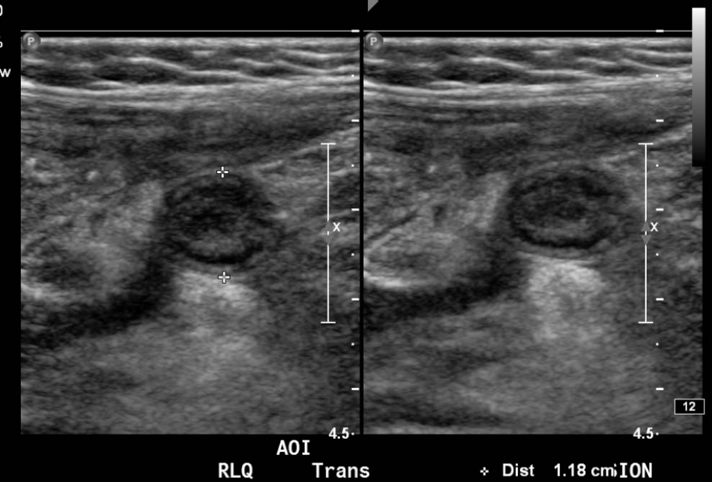 Appendicitis U:S Transverse Axis JETem 2017 - JETem