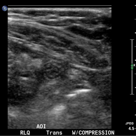 A Toddler with Abdominal Pain and Emesis - JETem