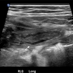 A Toddler with Abdominal Pain and Emesis - JETem