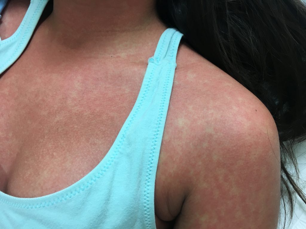 Infectious Mononucleosis Chest Morbilliform Rash JETem 2017 - JETem