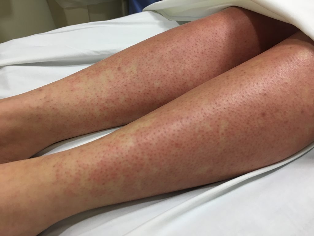 Infectious Mononucleosis Legs Morbilliform Rash JETem 2017 - JETem